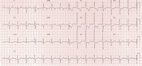 right ventricular strain on ekg.